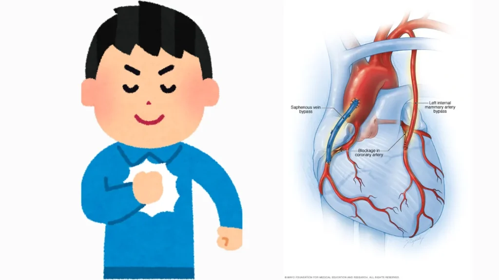 Illustration of chest pain with diagram showing heart artery blockage.