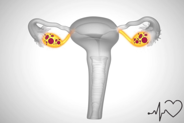 The ovaries are highlighted and contain several cysts or follicles, indicated by circular spots within the ovaries. looks like a case of PCOS.