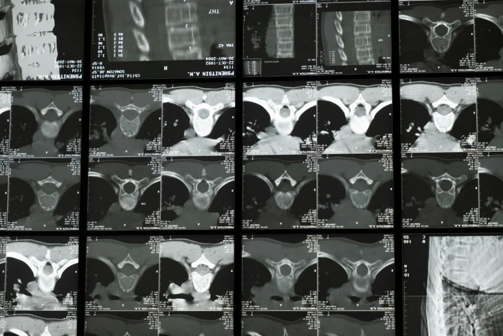 Multiple MRI or CT scan slices showing cross-sectional views of spine and pelvic region