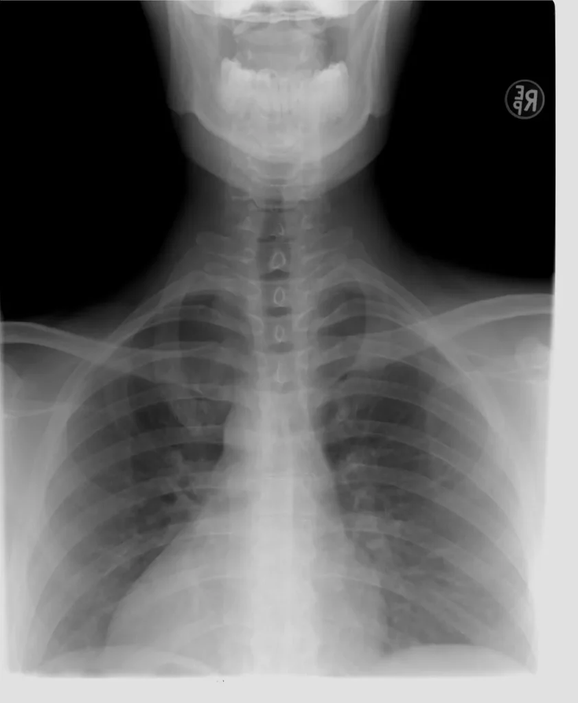 x-ray of a person's chest